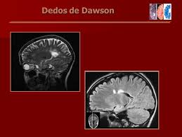El último pilar para diagnosticar una esclerosis múltiple es la exclusión de otras patologías que puedan afectar a sistema nervioso central. Irm En La Esclerosis Multiple Ppt Video Online Descargar