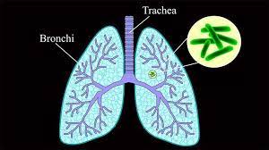 Tb is spread from person to person through the air. What Is Tuberculosis Everyday Health