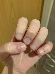 The little finger is often referred to as the pinky, pinkie (in scottish english), or baby finger. Does Anyone Else Have This With The Fingers That Have De On Them Missing Cuticle And Darkening Of Nails I M Freaking Out Dyshidrosis
