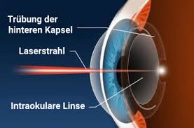 Komplikationen Nach Der Katarakt Operation Grauer Star Op