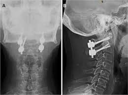 A Missed Traumatic Atlanto Axial Rotatory Subluxation In An Adult Pati Oaem