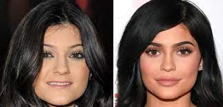 Let us check out the collection of kylie jenner before and after surgery photo and don't forget to give your feedback in the comment section. Kylie Jenner Talks Plastic Surgery What Do Her Before And After Photos Show The Inquisitr