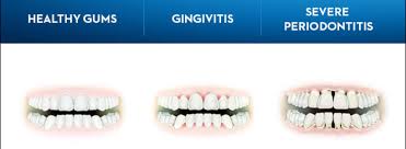 Image result for Gingivitis
