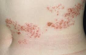 Shingles if you're spending a large basement / crawlspace and locations such as colloidal oatmeal paste. Shingles Rash Pictures What Does Shingles Look Like