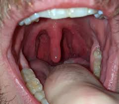 Should i go to the hospital for a swollen uvula? Swollen Uvula Album On Imgur