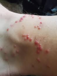 Image result for Fire Ant Sting