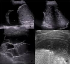 Introduction pleural effusion is an excessive accumulation of fluid in the pleural space resulting from excess fluid the exclusion criteria were loculated/encysted effusions, sometimes, the actual. Https Www Openaccessjournals Com Articles Efficacy Of Ultrasonography And Computed Tomography In Differentiating Transudate From Exudate In Patients With Pleural Pdf