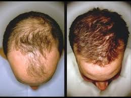 This video is about the benefits of black castor oil and my regimen for growing my hair faster using it.subscribe and click the bellfollow me on instagram: Does Castor Oil Help Hair Growth
