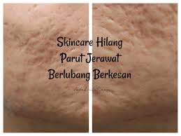 Penyebab bekas jerawat bopeng dan berlubang. Skincare Hilang Parut Jerawat Berlubang Berkesan Bebelsihat Com