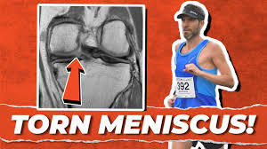 A torn meniscus repair consists of suturing the torn flap of tissue then anchoring it. How I Returned To Running Post Meniscus Tear Youtube