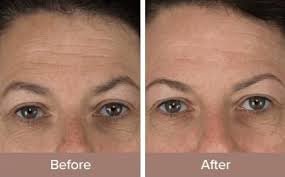 Microdermmd Microdermabrasion Microdermabrasion Treatment Microdermabrasion Machine