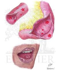 Image result for Small Intestinal Bleeding