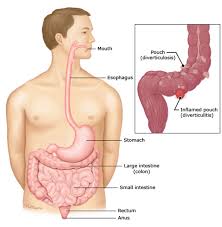 Image result for Diverticulitis