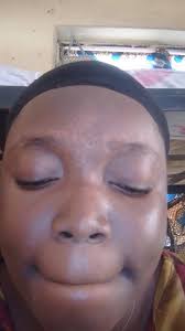 What can be done I am getting tired I get sweaty so quickly I can't even  feel my skin again It's all over my body especially my back and stomach.