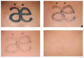 In the uk, you'll usually pay around £. Laser Tattoo Removal Manchester Tattoo Removal Manchester Org
