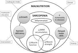 Looking for online definition of sarcopenia in the medical dictionary? Pediatric Sarcopenia A Paradigm In The Overall Definition Of Malnutrition In Children Ooi 2020 Journal Of Parenteral And Enteral Nutrition Wiley Online Library