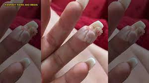 Collection by acrylic nails almond • last updated 6 weeks ago. Woman Claims Botched Acrylic Nail Job Nearly Cost Her A Finger I Ll Never Get My Nails Done Again Fox News