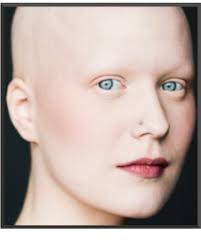 After losing to her to alopecia areata in july 2015 — and eventually developing alopecia universalis — devin tomb started when i developed a hair loss condition called alopecia universalis, i joined. Alopecia Universalis Uk Hair Consultants