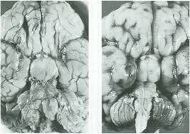 It is named for judith hall and philip pallister. The Early History Of Pallister Hall Syndrome Buried Treasure Of A Sort Sciencedirect