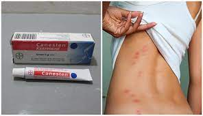 Kurap adalah jenis penyakit kulit yang berupa infeksi menular. 5 Obat Kurap Paling Ampuh Yang Aman Untuk Segala Jenis Kulit Boombastis