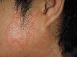 Maybe you would like to learn more about one of these? Fungal Infection On Face