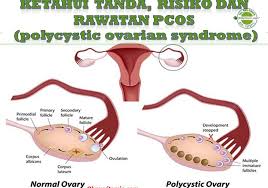 Fibroids miracle ebook review pedunculated fibroid surgery,fibroids after ablation uterine artery embolisation for fibroids,fibroid. Cyst Fibroid Archives Coach Bisnes Coach Detox Kurus Coach Penyusuan Susu Ibu Mentor Bisnes Pengedar Shaklee Pengedar Youth Pengedar Vivix 011 17547669