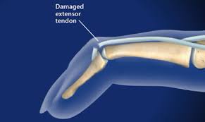 Treatment options include splinting and. Mallet Finger Surgeon Dallas