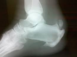 Learn a diy taping tip for helping with heel pain brought on by haglund's syndrome in this week's episode of research friday. Haglund S Deformity Wheeless Textbook Of Orthopaedics