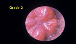 Les hémorroïdes externes sont des troubles gênants et douloureux, mais ils le sont plus quand ils sont accompagnés d'un saignement. Hemorroides Docteur Desantis Chirurgie Viscerale Et Digestive
