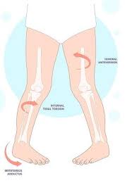 Image result for In-Toeing