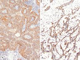Check spelling or type a new query. Glypican 1 Immunohistochemistry Does Not Separate Mesothelioma From Pulmonary Adenocarcinoma Modern Pathology