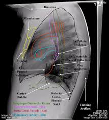 Chest xray is the most common examination on radiology department. Chest Undergraduate Diagnostic Imaging Fundamentals