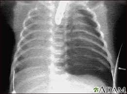 Image result for Pneumothorax