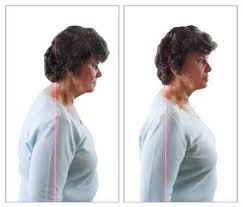 Hard lump on back of neck. Start Feeling Better By Getting Rid Of Your Buffalo Hump Pure Posture