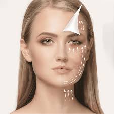 Plasmalifting con Plasmapen