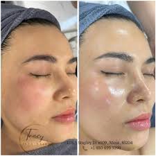 Bí quyết giúp làm da căng bóng sau 1 lần làm liệu trình BABY SKIN tại Tracy  iSpa Nails Chỉ sau 1 LIỆU TRÌNH duy nhất làn da bạn sẽ được hồi
