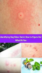 Bug Bites That Look Like Mosquito Bites But Hurt Identifying Bug Bites Here S How To Figure Out What Bit You Mosquito Bites Are Distressingly Familiar But Wha In 2020 Identifying Bug Bites Bug Bites Bed Bug Bites