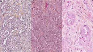 Check spelling or type a new query. Combined Grade And Nuclear Grade Are Prognosis Predictors Of Epithelioid Malignant Peritoneal Mesothelioma A Multi Institutional Retrospective Study Springerlink