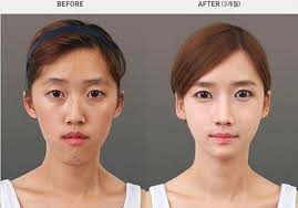 Korean Plastic Surgery Before And After Jaw Surgery And Chin Reduction