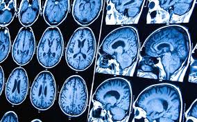6 sintomas do tumor cerebral