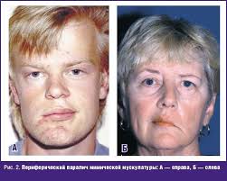 как лечить воспаление тройничного лицевого нерва в домашних условиях Porazheniya Licevogo Nerva V Praktike Vracha 09 13 Lechashij Vrach Professionalnoe Medicinskoe Izdanie Dlya Vrachej Nauchnye Stati