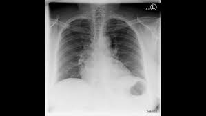 It is almost always the first imaging study ordered to evaluate for pathologies of the thorax, although further diagnostic imaging, laboratory tests. X Ray Imaging For Covid 19 Patients
