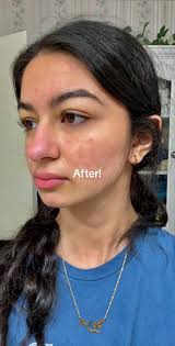 Accutite Vorher Nachher