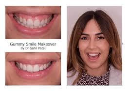 Gummy Smile Makeover Transform Your Smile In Minutes Harley Street Smile Clinic