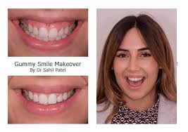 So how do we fix these gummy smiles? Gummy Smile Makeover Harley Street Smile Clinic