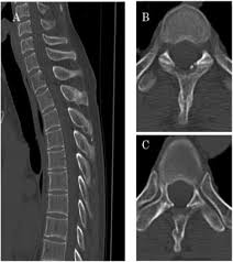Transverse process fracture is a rare and stable fracture of the spine. Multi Level Isolated Spinous Process Fractures With Delayed Deterioration Observed Radiographically A Case Report Sciencedirect