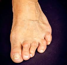 Image result for Hammer toe