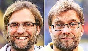Haartransplantation vorher nachher bild klopp bart haartransplantation bart haare. Frisur Klopps Haarstraubender Transfer