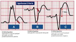 Eletrocardiograma no infarto agudo do miocárdio. Voce Sabe Identificar Iam Na Vigencia De Bre Cardiosite
