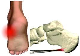 Smerter på øvre del av hælbenet. Haelsporer Plantar Fasciitis Klinik For Fodterapi Ved Kia Remond